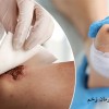 پلاسما تراپی زخم؛ روشی نوین برای درمان زخم و سوختگی
