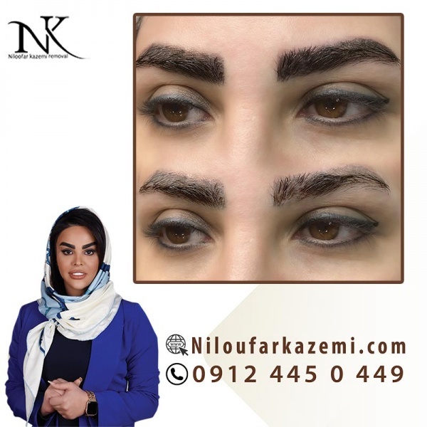 بهترین مرکز ریموو ابرو در تهران با خدمات تخصصی