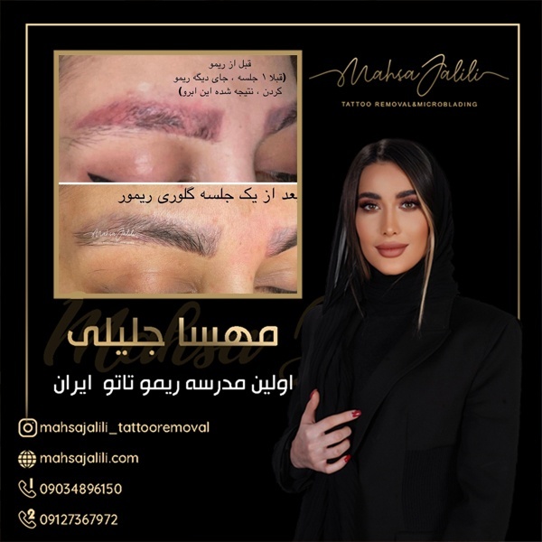 بهترین مرکز ریموو ابرو در تهران 09127367972