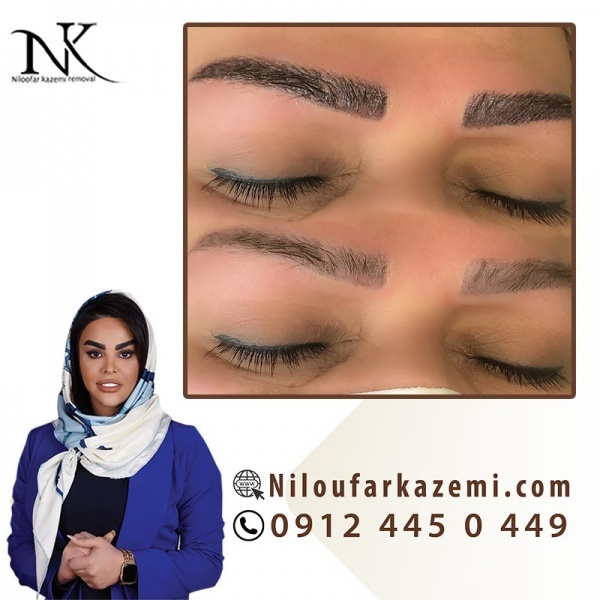 ریموو تاتو قدیمی در مرکز ریموو تاتو نیلوفر کاظمی