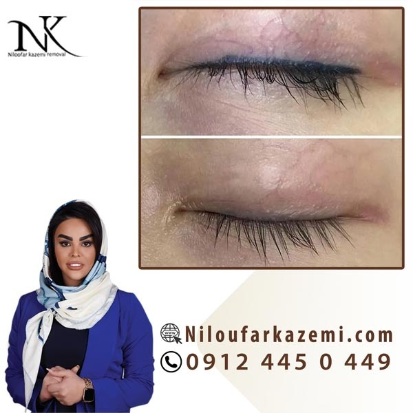 ریموو تاتو خط چشم بدون لیزر
