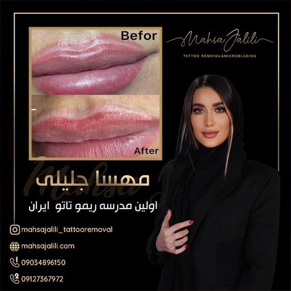 ریموو تاتو خط لب با بروزترین تکنیک ریموو